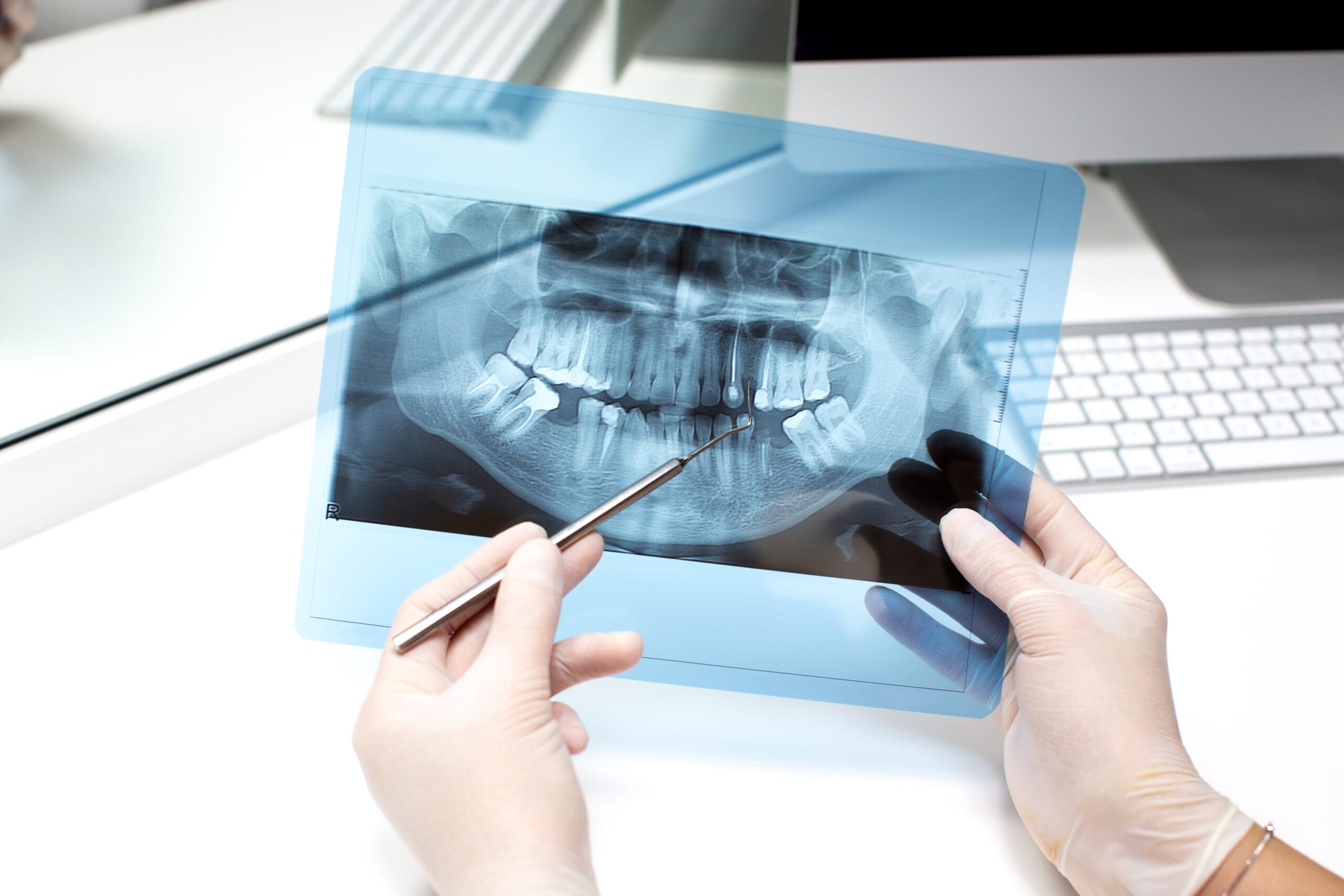 radiografia denti